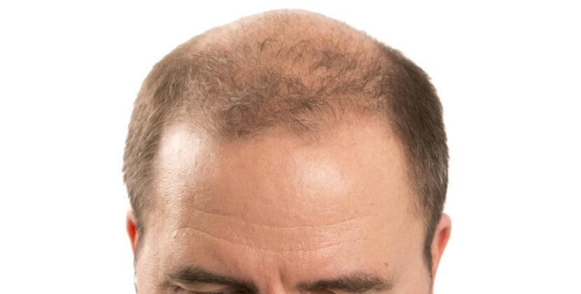 Reasons for balding in men